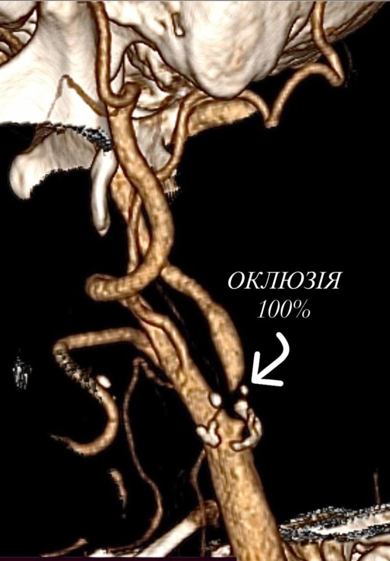 Після інсульту та шунтування: у лікарні Пирогова врятували пацієнта з повною оклюзією артерії