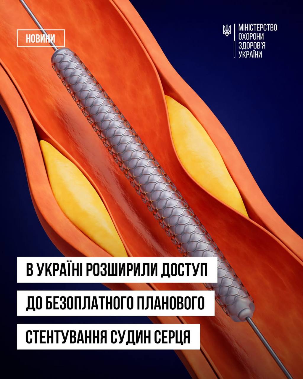 З 2026 року планове стентування серця в Україні стало безоплатним: де отримати послугу на Вінниччині