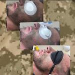 У Гайсині підприємниця відкрила у салоні краси послугу видалення наслідків вибухових травм для ветеранів