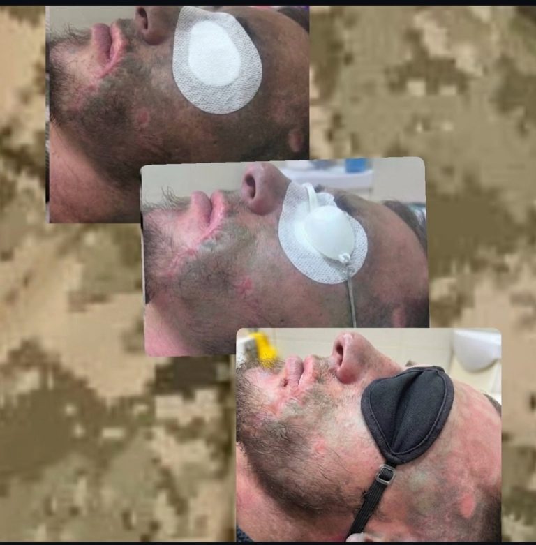 У Гайсині підприємниця відкрила у салоні краси послугу видалення наслідків вибухових травм для ветеранів